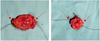 Short- and long-term outcomes of laparoscopic low anterior resection with “dog ear” invagination anastomosis for mid and distal rectal cancer a propensity score matched analysis